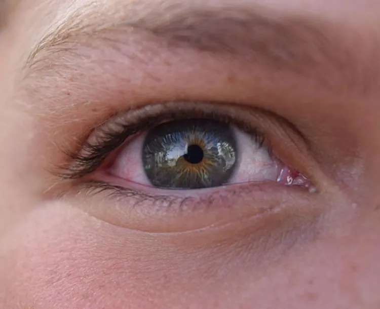 Ojos rojos podrían ser síntomas de glaucoma