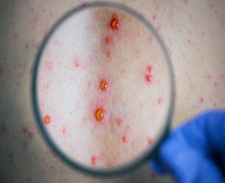 Culebrilla, se activa con el estrés y puede dejarte ciego