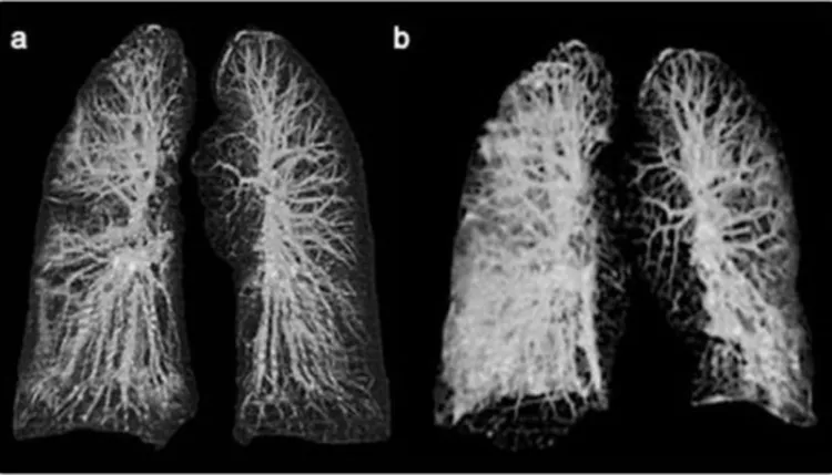 Así lucen los pulmones con coronavirus