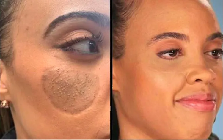 Mujer se horroriza cuando le crece vello púbico en la cara tras un injerto de piel