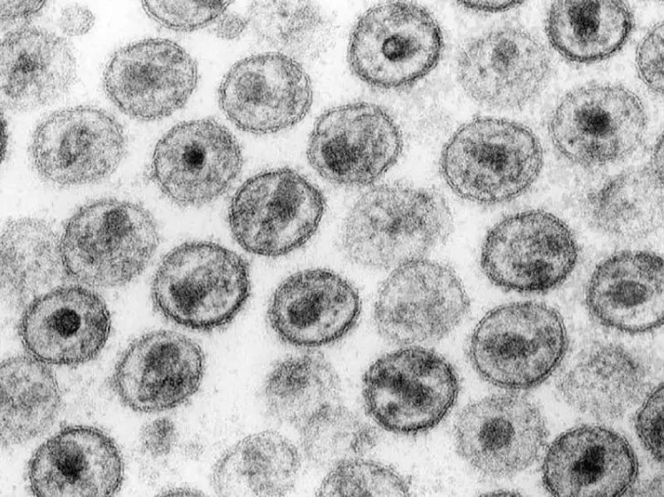 Identifican nueva variante del VIH altamente contagiosa