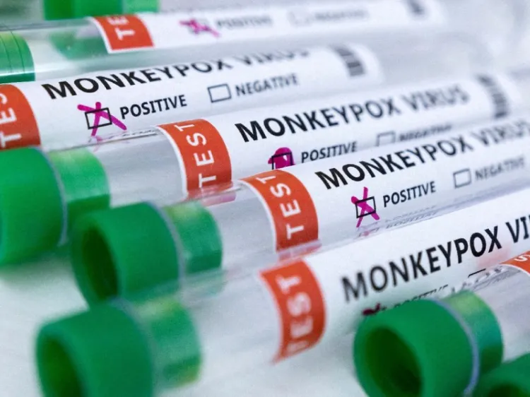 Registra México 147 casos de viruela del mono