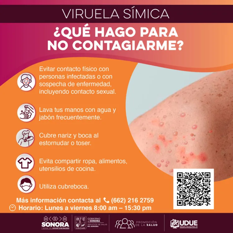 Descartan la propagación de una nueva pandemia por viruela símica