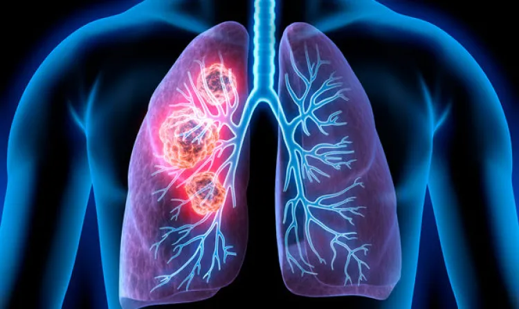 FDA de EU aprueba el medicamento contra el cáncer de pulmón