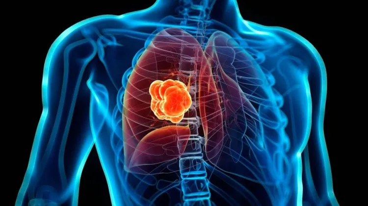 Cada año México presenta más de 7, 500 casos nuevos de cáncer de pulmón
