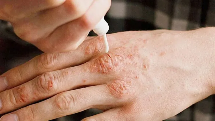 ¿Cómo detectar si tienes lepra?